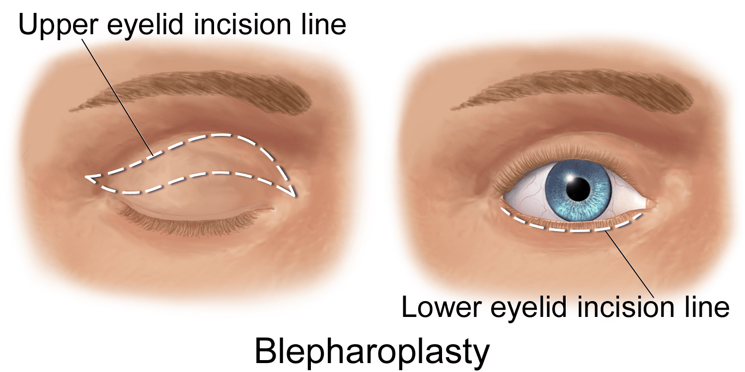 A schematic of possible incision sites in upper and lower eyelid surgery. The approach is selected according to eyelid anatomy and the purpose of surgery.