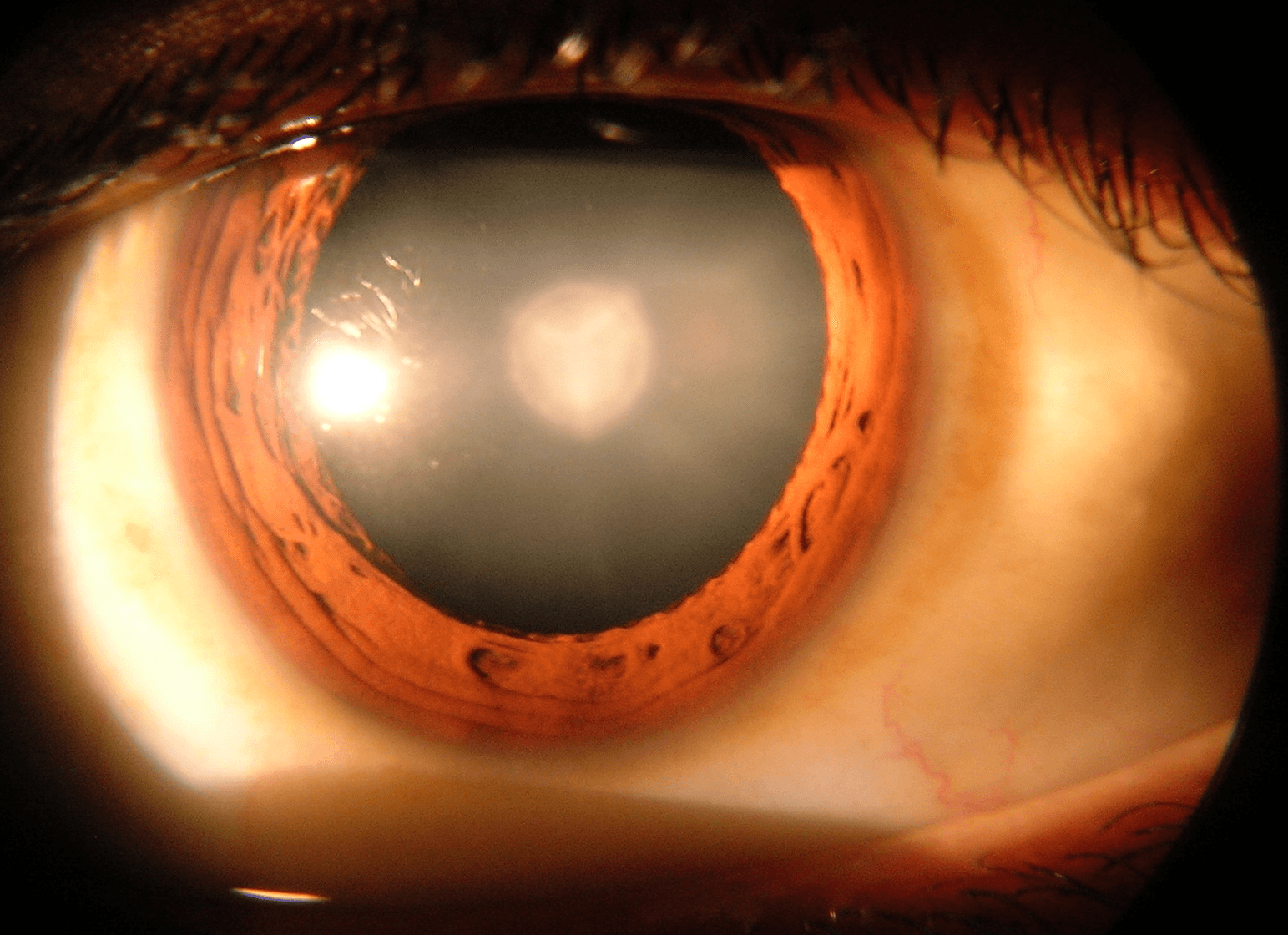 A clinical example of advanced cataract with marked lens clouding. Earlier cataracts may be less apparent from outside the eye.