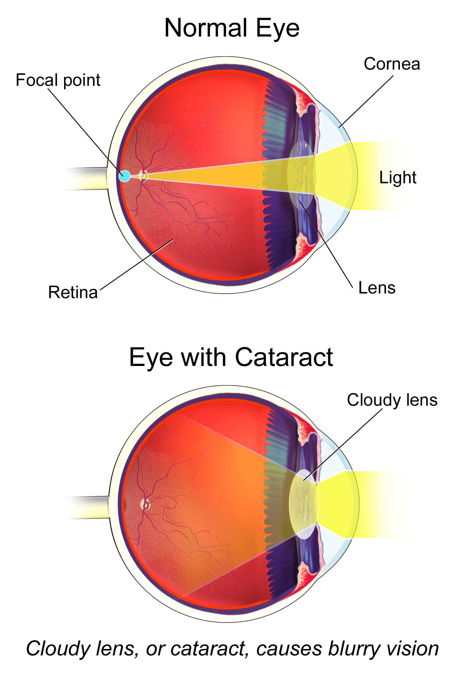 Diagram comparing a clear eye lens with cataract and scattered light