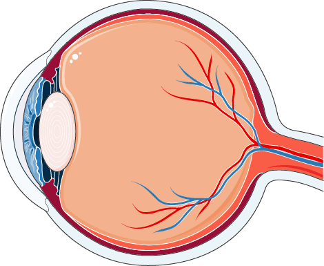 An eye cross section with a cloudy lens, showing where cataract occurs inside the eye.