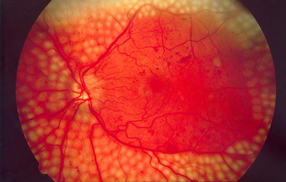 A retinal photograph showing scatter laser treatment marks in diabetic retinopathy, one particular type of retinal laser treatment.