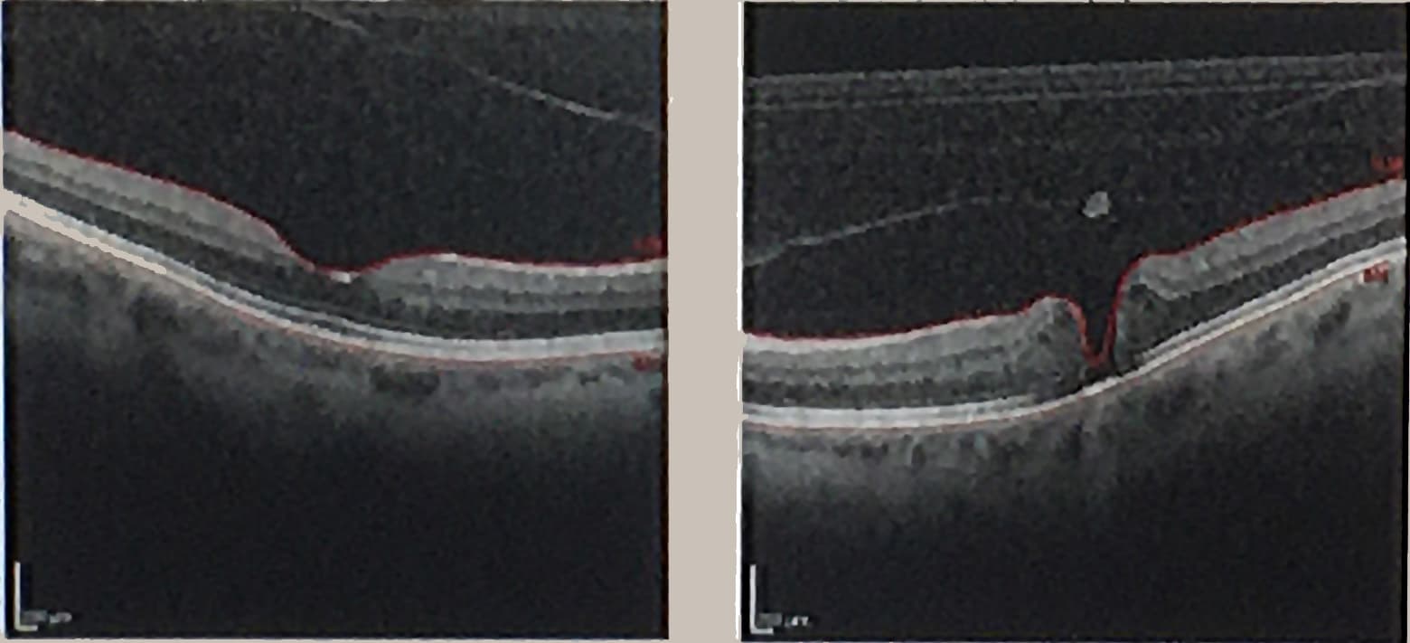 OCT showing a macular hole in the right panel, alongside a comparison section in the left panel.