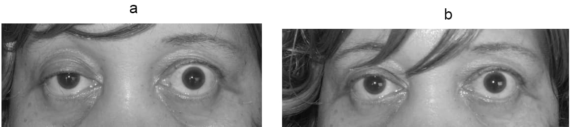 A photograph from a 2008 case report showing eyelid drooping and the change observed after a historical Tensilon diagnostic test. It illustrates variation in eyelid drooping and is not a current testing or treatment recommendation.