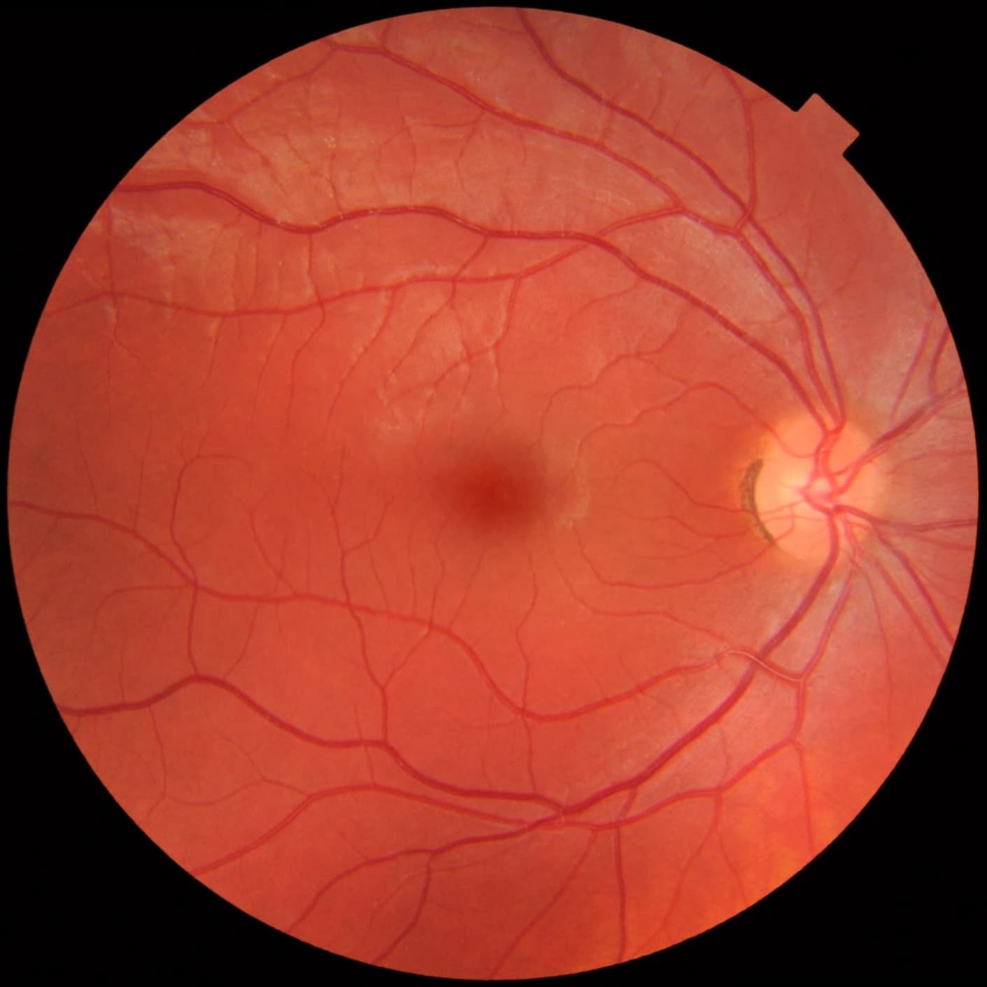 A photograph of a healthy retina. Blood vessels and the optic disc, appearing brighter on the right side of the image, are visible.