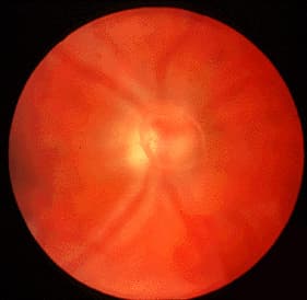 A clinical photograph of vitreous opacities that may be perceived as floaters. An image alone cannot establish whether there is vitreous detachment or a retinal problem.