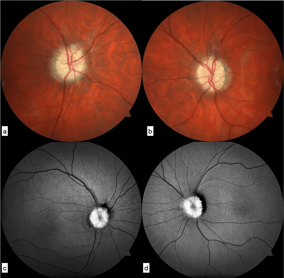 A published clinical example of optic disc drusen. Fundus photographs appear above and autofluorescence images below, highlighting some deposits.